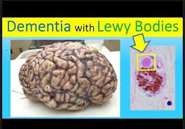 Jul 04, 2017 · the dementia with lewy bodies (dlb) consortium last reported on diagnosis and management in december 2005, and its recommendations have been widely cited for both clinical and research use. News Anchor Dies By Suicide Believing He Had Lewy Body Dementia Al Com