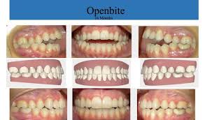 You may need to wear braces or use aligners for a year or more. How Do Braces Affect Your Face