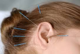 Acupuncture ear piercing weight loss. Acupuncture For Weight Loss Is It Possible