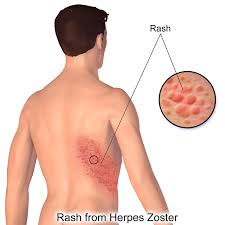 Image result for sweat rash on back