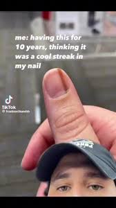 Image result for Acral lentiginous melanoma nail
