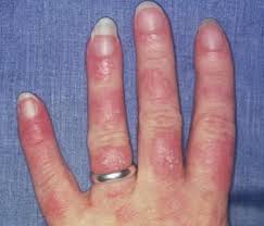 We did not find results for: 34 Lupus Ideen Ernahrung Hypothyreose Ernahrung Fibromyalgie