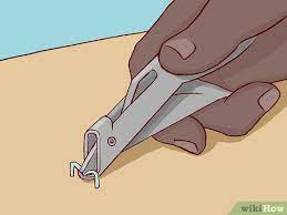 Staple removers don't just pull straight up and out. How To Remove Surgical Staples 8 Steps With Pictures Wikihow