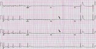 We did not find results for: Cardiovascular Complications Of The Guillain Barre Syndrome American Journal Of Cardiology