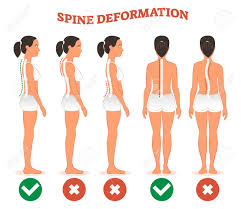 Plummet bounce back flatten out hold steady. Spine Deformation Types And Healthy Spine Comparison Diagram Royalty Free Cliparts Vectors And Stock Illustration Image 99334702