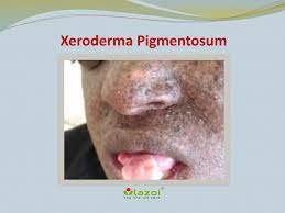 An endocrine society clinical gynecol endocrinol 2007; Xeroderma Pigmentosum Causes Symptoms Daignosis Prevention And Treatment By Lazoithelife Issuu