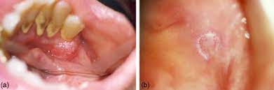 Systemic lupus erythematosus (sle) is a chronic inflammatory disease, which is characterized by objective: Verruciform Xanthoma Coexisting With Oral Discoid Lupus Erythematosus British Journal Of Oral And Maxillofacial Surgery