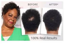 As you may or may not know, nearly 1/3 of all. Keranique Hair Regrowth System Help Hair Loss Hair Loss Men Keranique Hair Regrowth