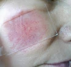 Image result for Diascopy