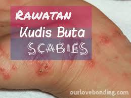 Kudis buta atau skabies adalah sejenis penyakit kulit yang boleh menjangkiti individu pada semua peringkat umur. Cara Nak Ubat Kudis Buta Rawatan V