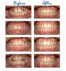 We did not find results for: Really Bad Teeth Before And After Braces Orthodontics Bad Teeth Orthodontics Braces