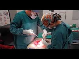 Liver Transplant Surgery Transplant Liver Surgery