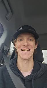 First Adjustment Immediate Dentures Before and After