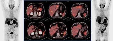 Specifically, they form in your liver, which is an organ that cleans your blood and helps your body process nutrients. Ga 68 Psma Pet Ct With Multifocal Liver Metastases In Download Scientific Diagram
