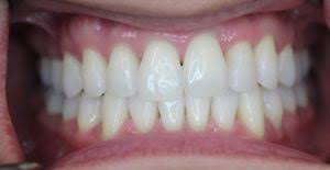 Toothpaste that gives you a healthy smile, with specialized solutions tailored to you. Zoom Whitening Everything You Need To Know 209 Nyc Dental