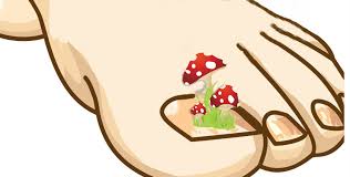 Los hongos en las uñas u onicomicosis son una condición común de la piel en donde un hongo infecta una parte de la uña, incluido el lecho (tejido debajo de la uña), la matriz (tejido del que crece la uña) o la placa. Onicomicosis Hongos En Las Unas De Los Pies Doctora Lorea Bagazgoitia Dermatologia