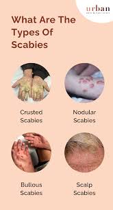Image result for scabies effects on the human body