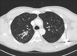 Aspergillosis in cats aspergillosis is an opportunistic fungal infection caused by the aspergillus, a species of common mold found throughout the environment, including dust, straw, grass clippings, and hay. Allergic Bronchopulmonary Aspergillosis Radiology Case Radiopaedia Org