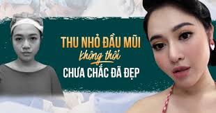 Chỉ thu nhỏ đầu mũi, liệu dáng mũi có đẹp như bạn mong muốn?
