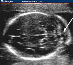 ultrasonographic soft markers of aneuploidy in second trimester