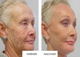 Dermatologen Kann Nicht Glauben Dass Sie Das Verwendet Hat Um Die Falten Zu Loschen Naturliche Arzt Laser Treatment Instantly Ageless Anti Aging
