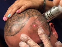 When it comes to your appearance, you deserve the best care that money can buy. New Skin Launches Campaign To Remove Tattoos In 10 Cities Jails To Jobs