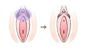 副皮切除術 | 【腟ペディア】女性器整形・腟ハイフのクリニック検索サイト