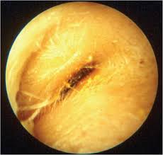Image result for Acute Otitis Externa