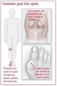 Gout Harvard Health