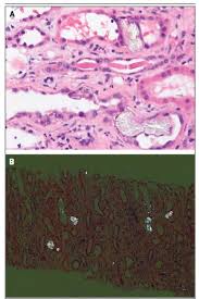 Calcul rénal cristaux phosphate de calcium traitement. Une Insuffisance Renale Liee Au The Sciences Et Avenir