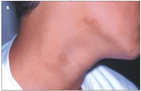 Image result for Postinflammatory Hyperpigmentation