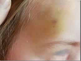 Wann nach sturz auf kopf zum arzt? Wib Unfall Im Kindergarten Und Krank Mamaz