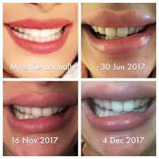 The smile's angle, width, toothiness, and degree of crookedness varied across each face. Uneven Smile After Botox Will It Ever Go Photos
