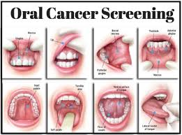 Symptoms and signs of cancer of the larynx, the organ at the front of the neck, include hoarseness, a lump in the neck, sore throat, cough, problems breathing, bad breath, earache, and weight loss. Mccall Family Dentistry Blog Oral Cancer Know The Signs