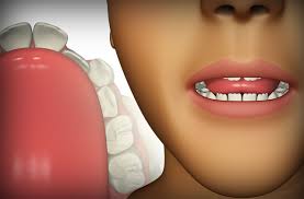 Que Causa Los Dientes Torcidos Myobrace