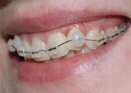 It's pretty easy and useful. Do You Need To Put Wax On Teeth Braces For The First Few Days You Put Them On Quora