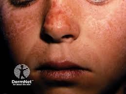 Image result for Porphyrostemma