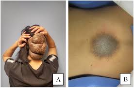 Image result for Blue Nevus