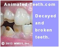Cavities that only affect the enamel layer can usually be treated by placing a composite filling. How Long Does It Take A Cavity To Form Why