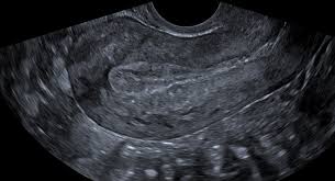 Transabdominal pelvic ultrasound can detect most larger abnormalities such as large fibroids transvaginal ultrasound gives the best resolution and visualization of the female pelvic structures. Pelvic Ultrasound Insight Medical Imaging