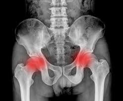 Image result for Sacroiliac Dysfunction