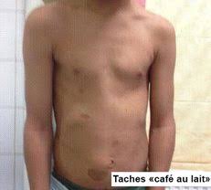 Les personnes atteintes de cette maladie présentent des tumeurs non cancéreuses le long des trajets nerveux. Chr De La Citadelle Citadoc