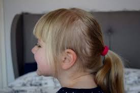 By doing so you will be able to identify precipitating factors that contribute the your hair twirling. Did Cutting Amy S Hair Short Stop Her Compulsive Hair Pulling Habit We Re Going On An Adventure