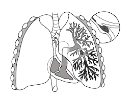 According to medical jargon, pulmonary embolism is an abrupt blockage caused in the lungs when an artery or blood vessel has a blood clot in it, thus hindering the flow of blood. Pulmonary Embolism Wikipedia
