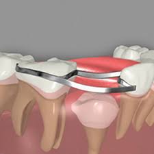 Who is right for dental bonding? General Dentistry Technology Cosmetic Dentistry Periodontal Care Preventive Dentistry In Bowie