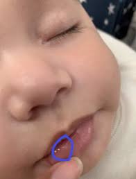 Bolita Con Liquido En El Labio Inferior De Mi Bebe Club De Bebes Mayo 2020 Babycenter