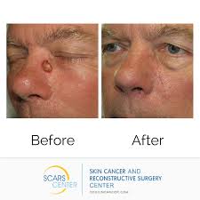 Skin cancer rates are more than 4 times higher than they were in the late 1970's in great britain. Scars Center Scarscenter Twitter