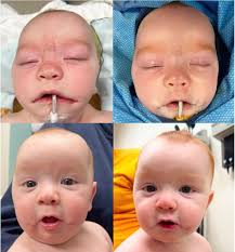 Remember this guy?! He had a bilateral Tessier 7 cleft repaired 3 months  ago. He came in today for follow up and is doing great. His photos show the  typical progression of