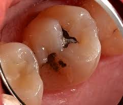 Image result for Tooth Fracture