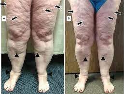 Top 10 Rarest Diseases Can Infect The Human Topteny Com Dercums Disease Rare Disease Diseases Pictures